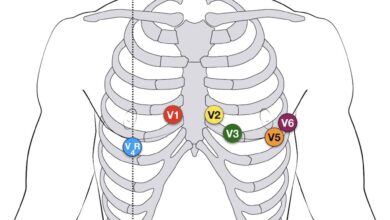 leads ecg placement